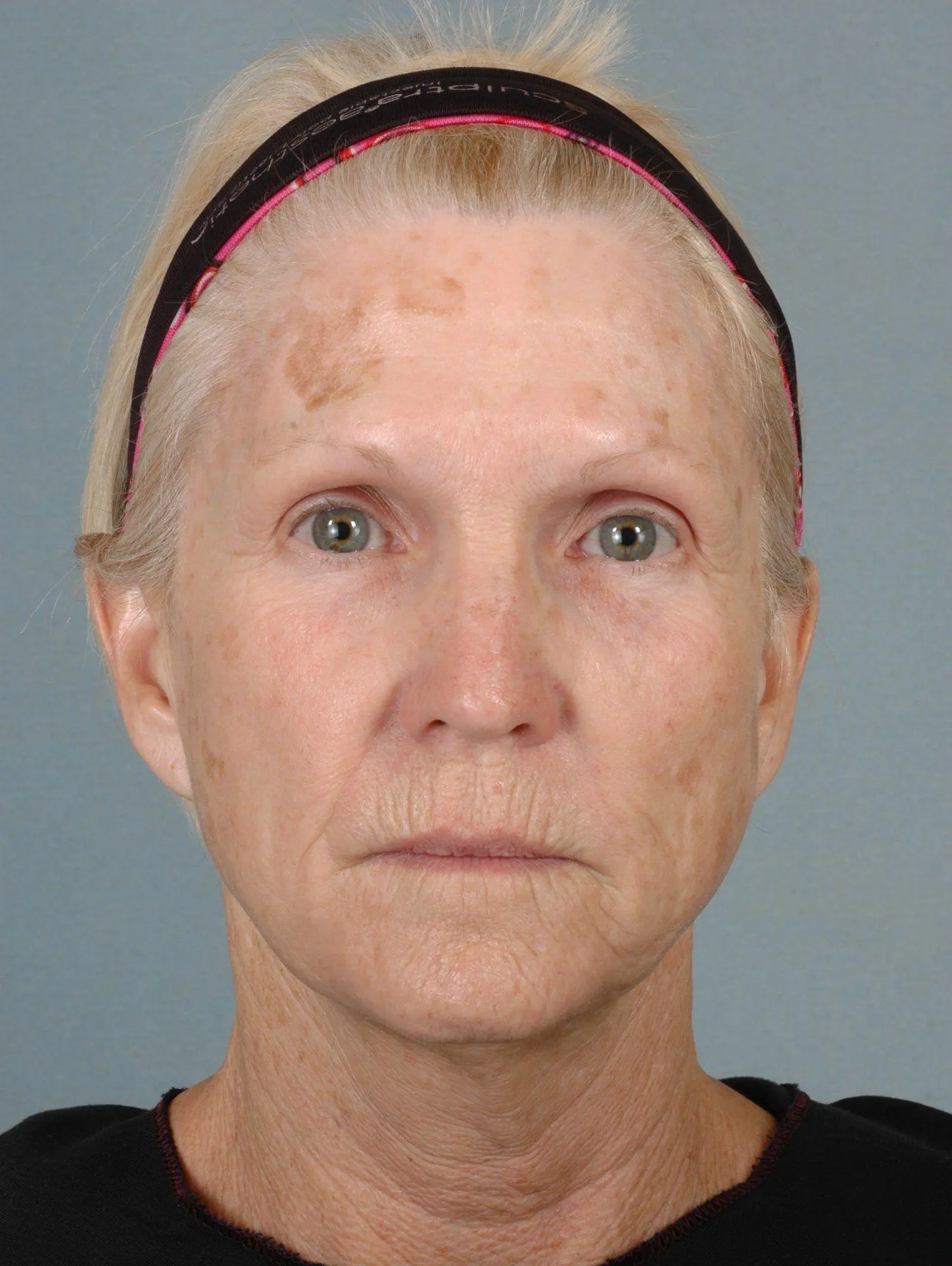Laser Resurfacing Patient Photo - Case 15893 - before view-