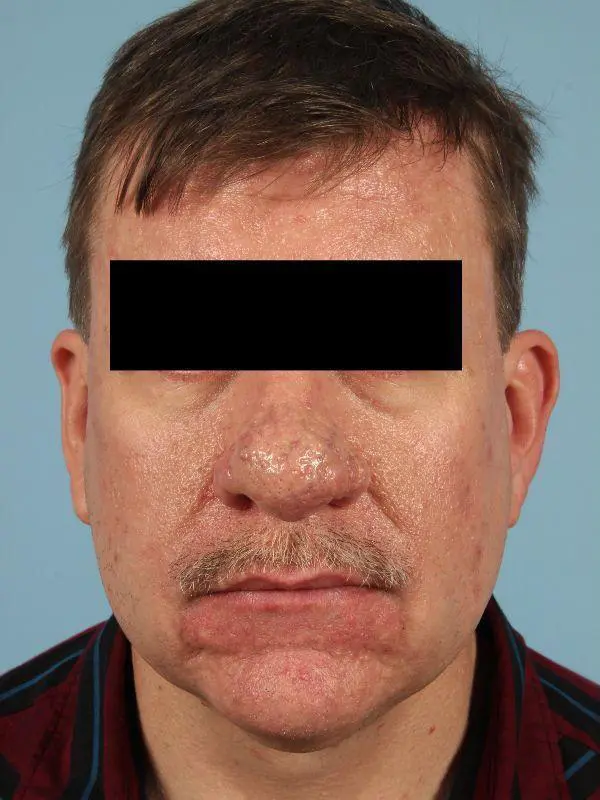 Laser Resurfacing Patient Photo - Case 15922 - before view-