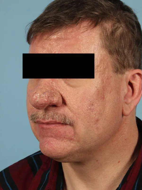 Laser Resurfacing Patient Photo - Case 15922 - before view-2