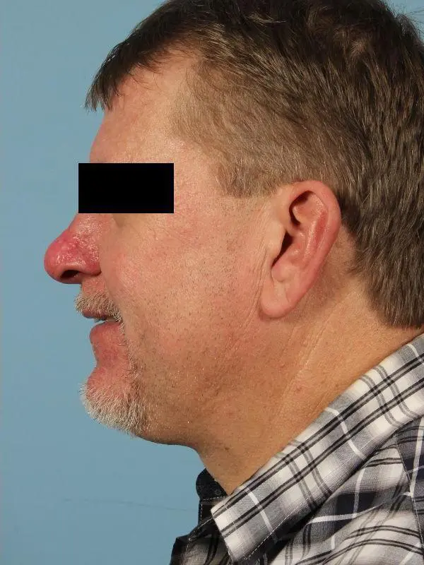 Laser Resurfacing Patient Photo - Case 15922 - after view-1