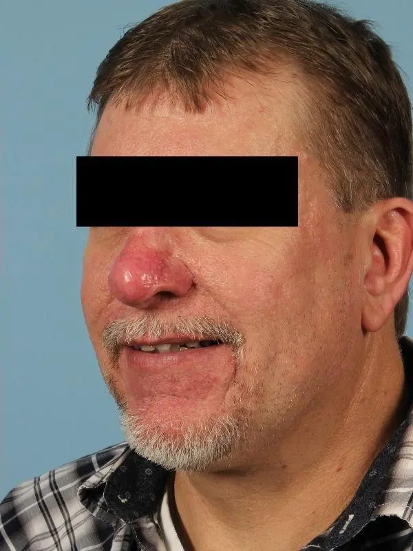 Laser Resurfacing Patient Photo - Case 15922 - after view-2