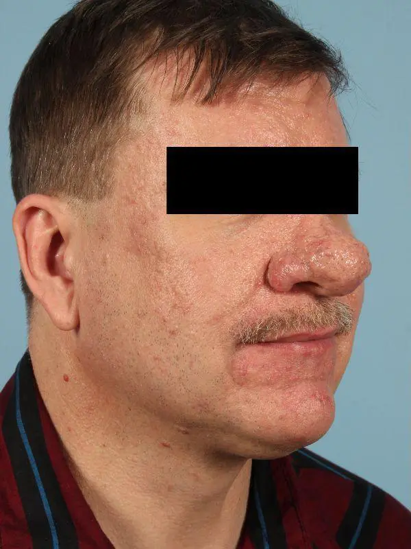 Laser Resurfacing Patient Photo - Case 15922 - before view-3