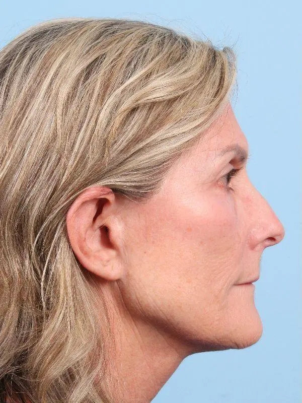 Laser Resurfacing Patient Photo - Case 15958 - before view-2