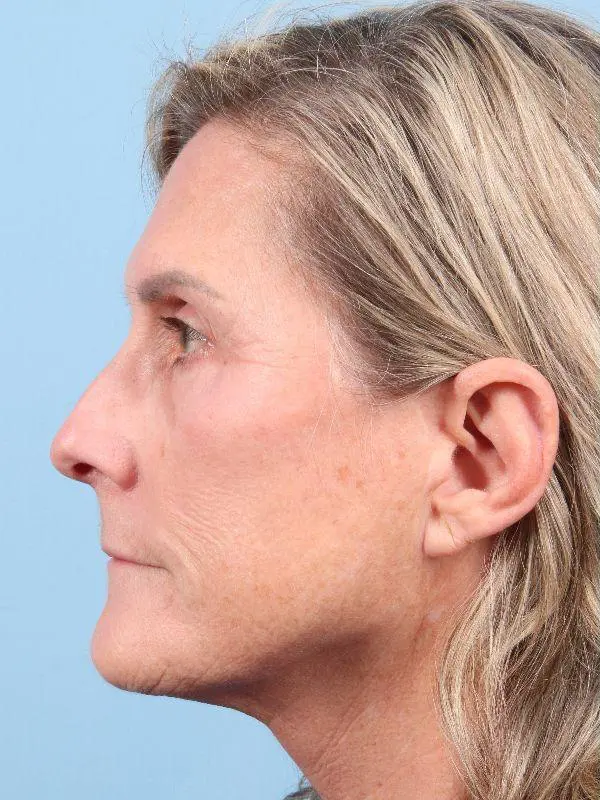 Laser Resurfacing Patient Photo - Case 15958 - before view-1