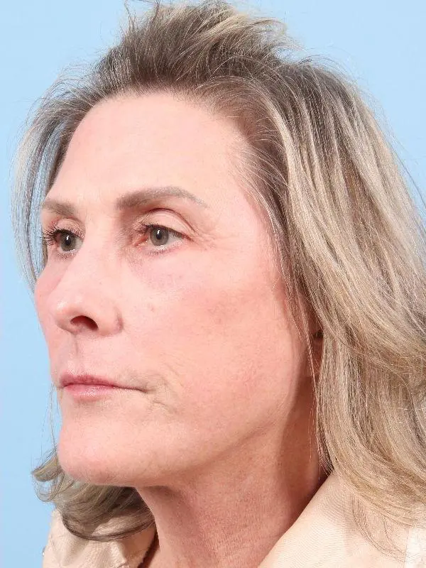 Laser Resurfacing Patient Photo - Case 15958 - after view-3