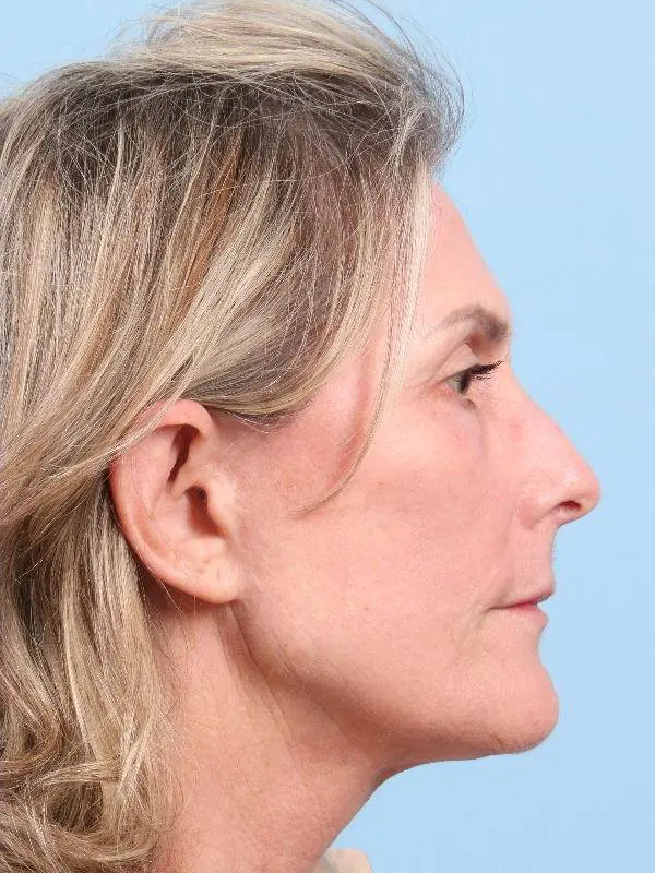 Laser Resurfacing Patient Photo - Case 15958 - after view-2