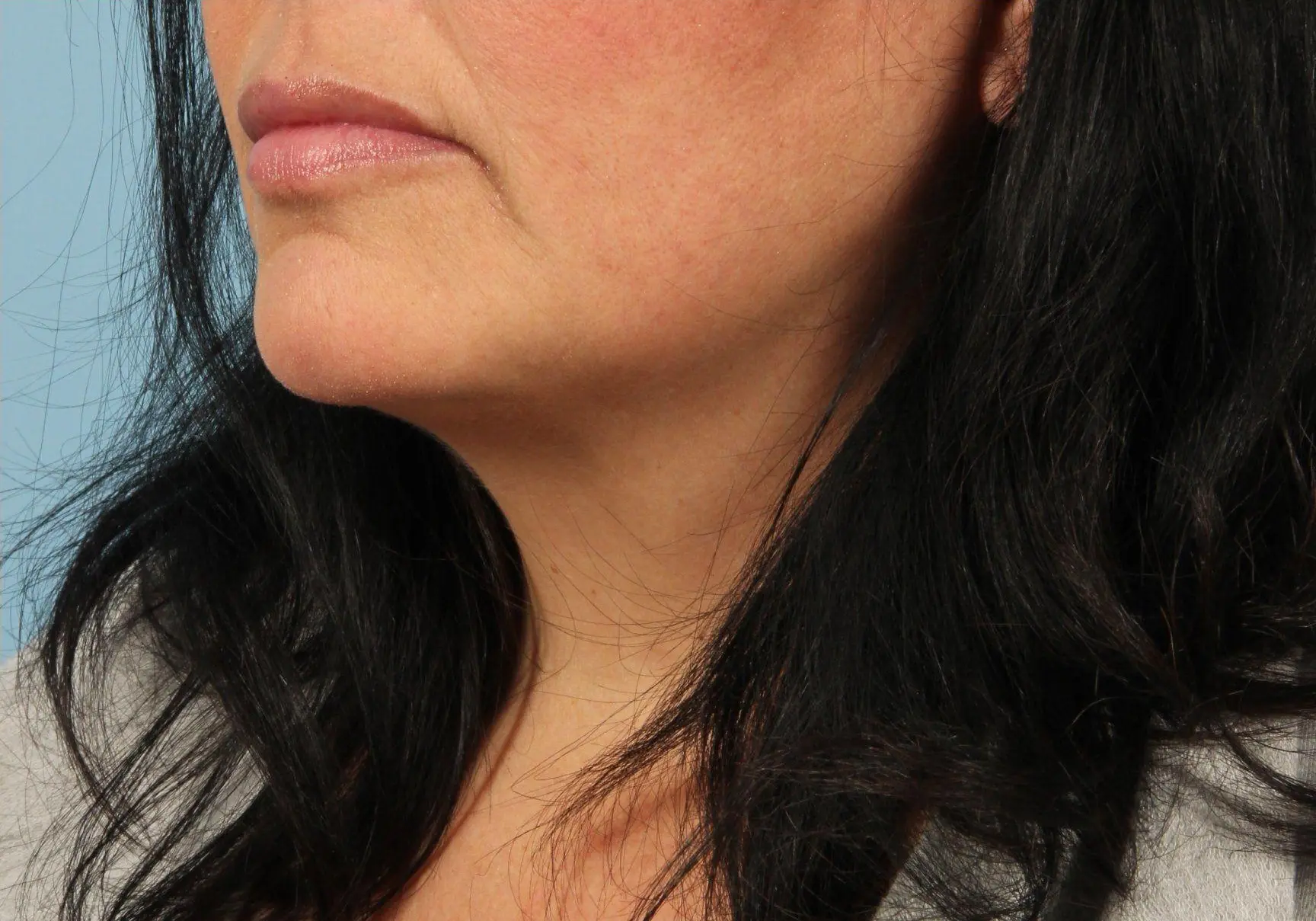 Lip Augmentation Patient Photo - Case 16313 - after view-1