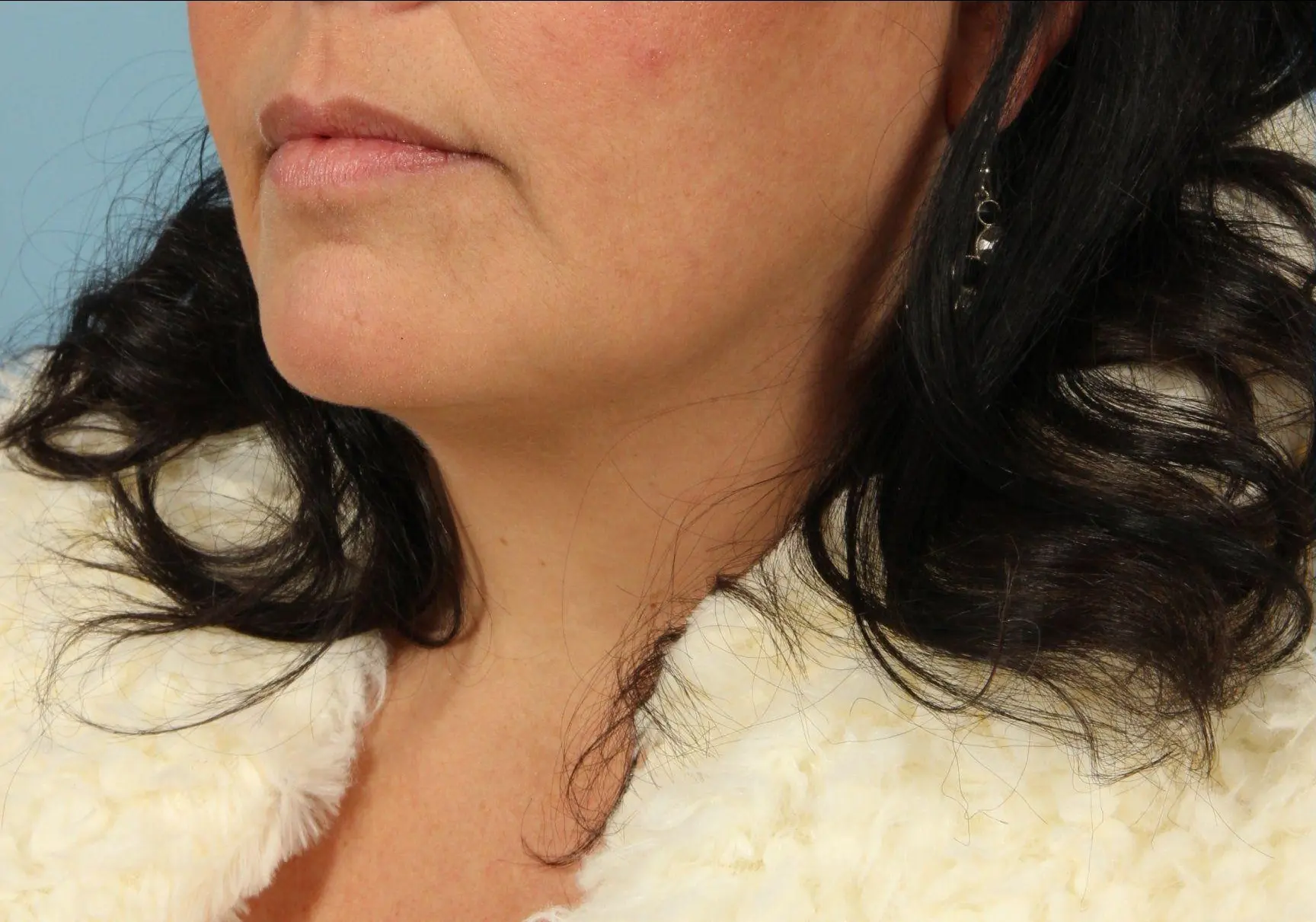 Lip Augmentation Patient Photo - Case 16313 - before view-1