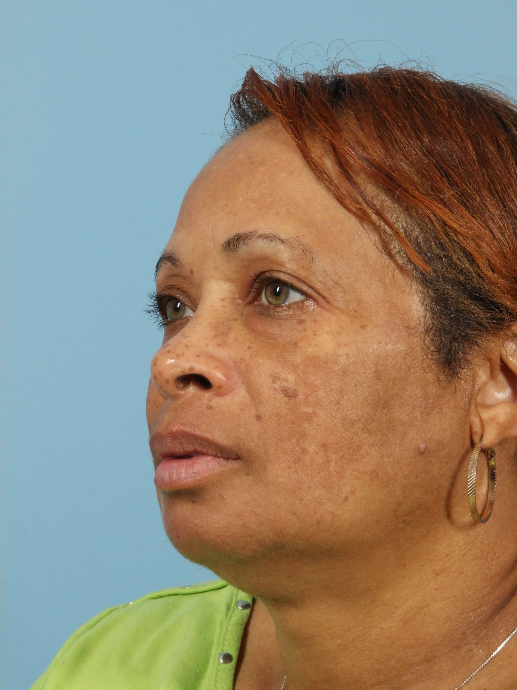 Obagi Patient Photo - Case 16354 - after view-3