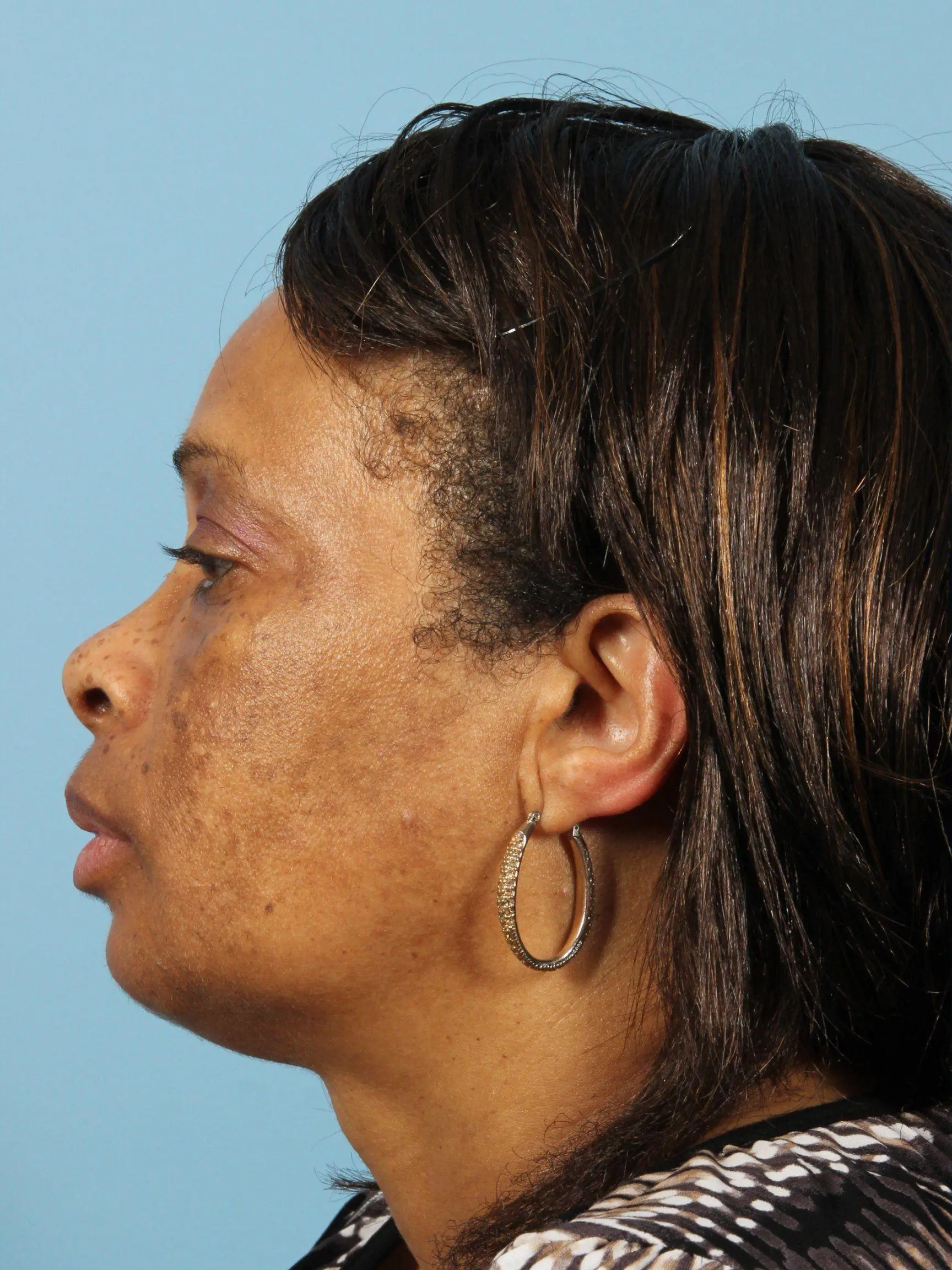 Obagi Patient Photo - Case 16354 - before view-1