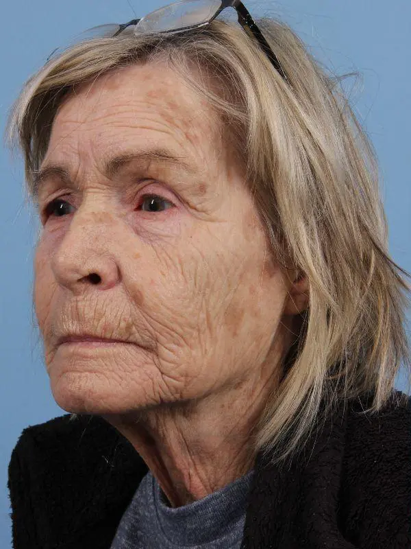 Obagi Patient Photo - Case 16378 - before view-3