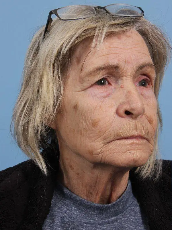 Obagi Patient Photo - Case 16378 - before view-4