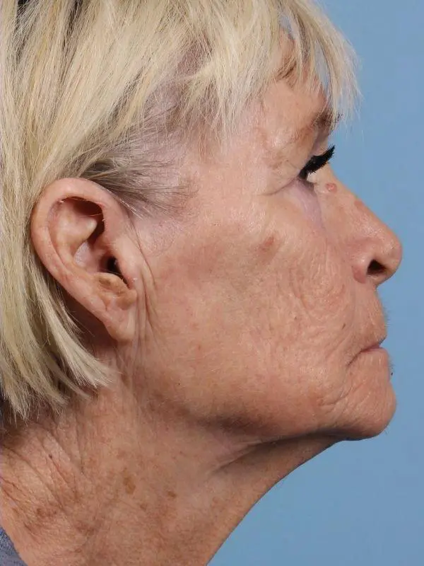 Obagi Patient Photo - Case 16378 - after view-2