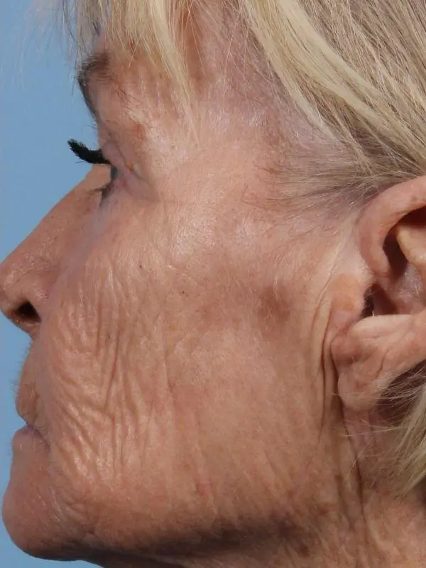 Obagi Patient Photo - Case 16378 - after view-1