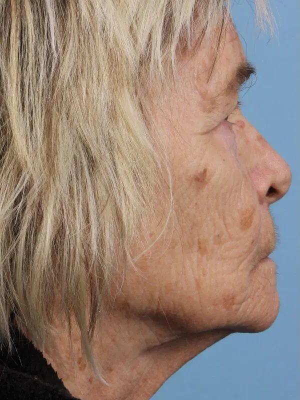 Obagi Patient Photo - Case 16378 - before view-2