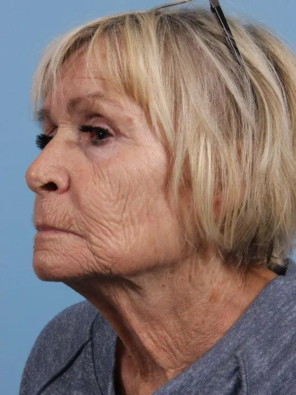 Obagi Patient Photo - Case 16378 - after view-3