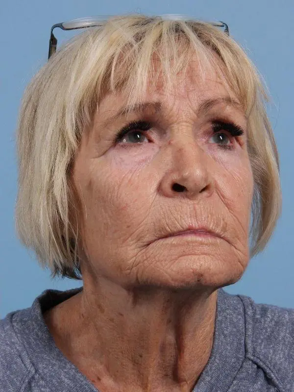 Obagi Patient Photo - Case 16378 - after view-4