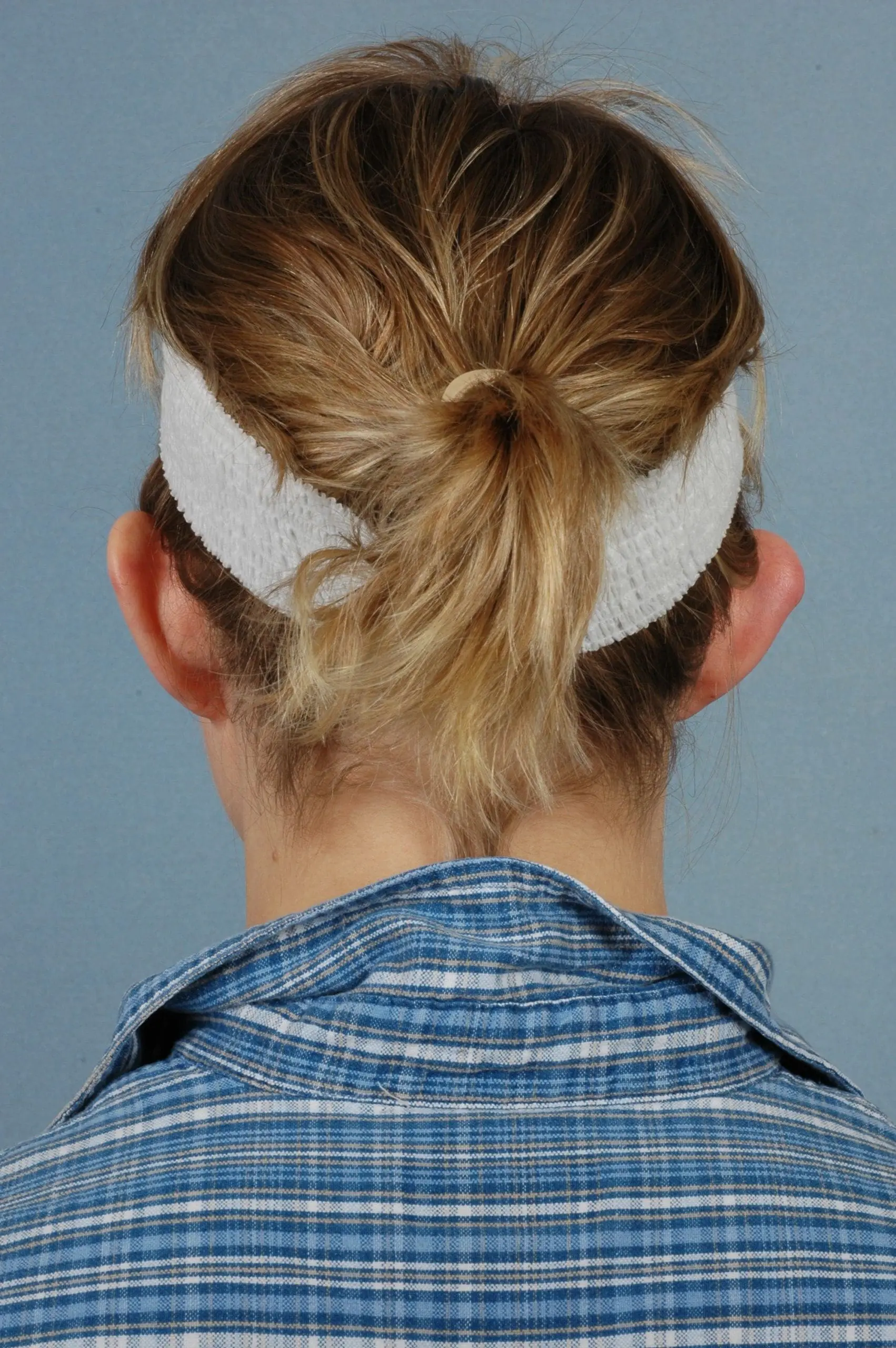 Otoplasty Patient Photo - Case 16407 - before view-1