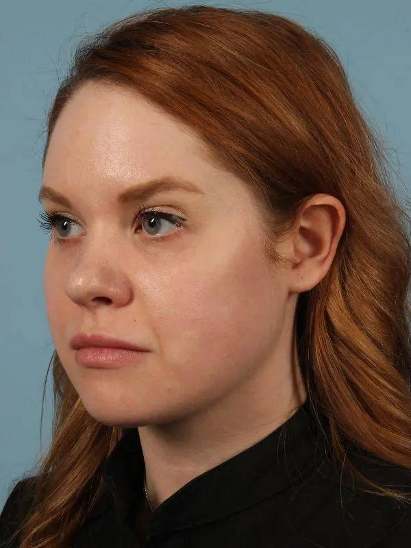 Rhinoplasty Patient Photo - Case 16526 - before view-3