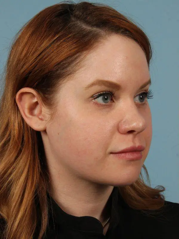 Rhinoplasty Patient Photo - Case 16526 - before view-4