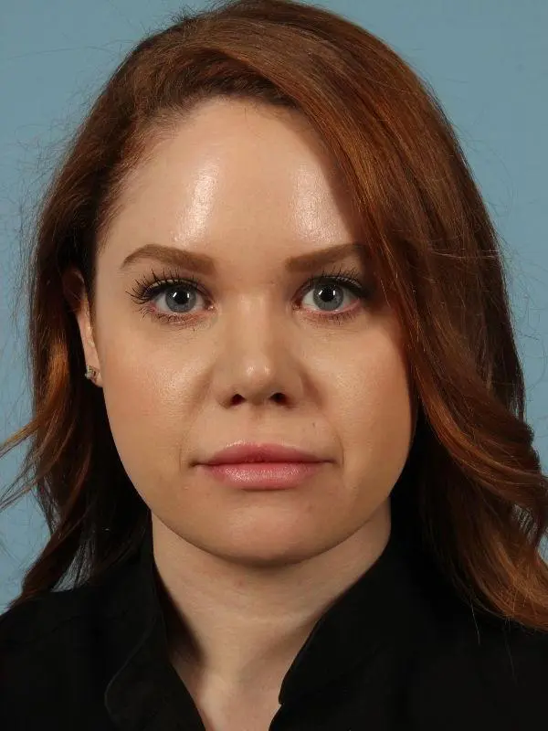 Rhinoplasty Patient Photo - Case 16526 - after view