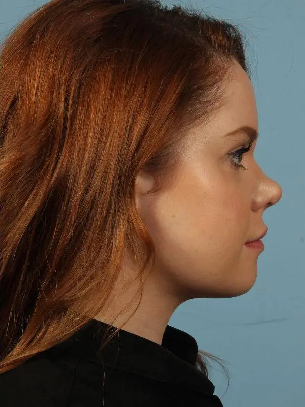 Rhinoplasty Patient Photo - Case 16526 - after view-2