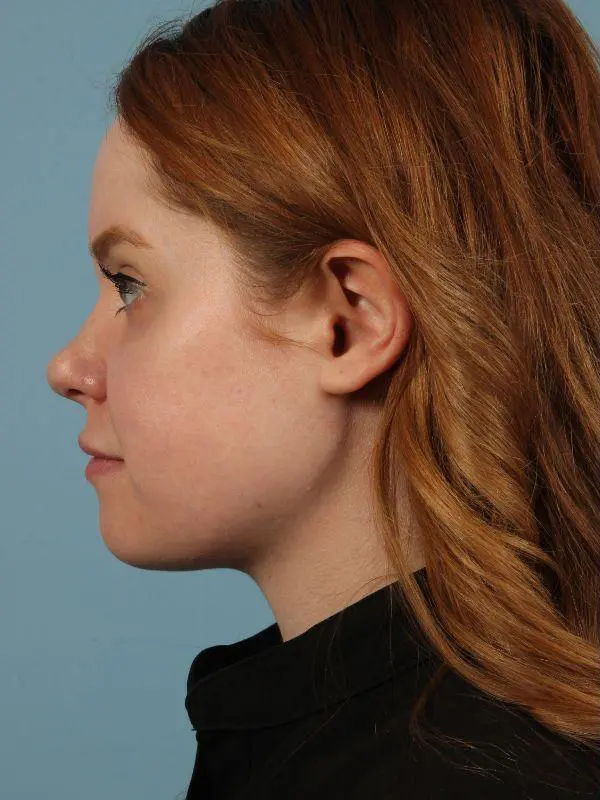 Rhinoplasty Patient Photo - Case 16526 - before view-1