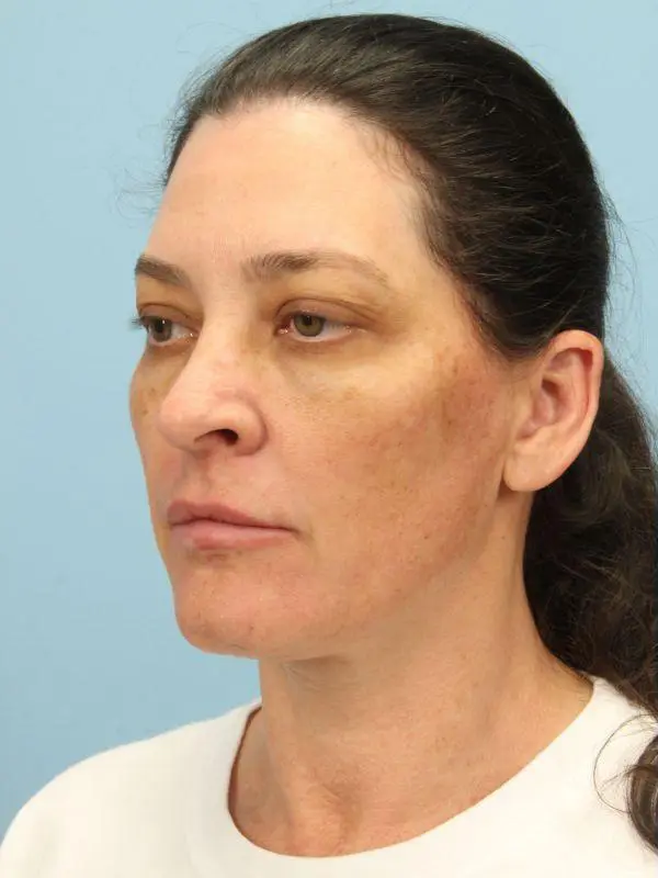 Y Lift Patient Photo - Case 16819 - before view-3