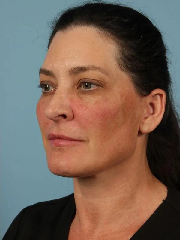 Y Lift Patient Photo - Case 16819 - after view-3