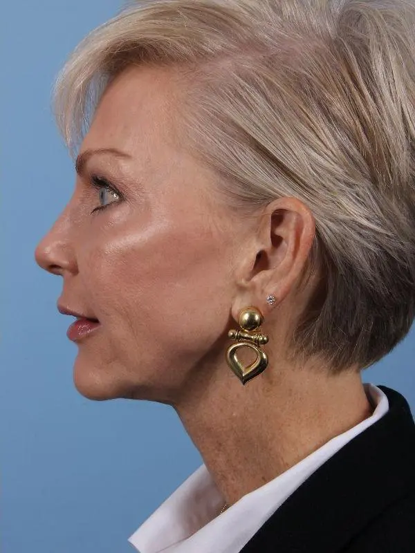 Y Lift Patient Photo - Case 16845 - after view-1