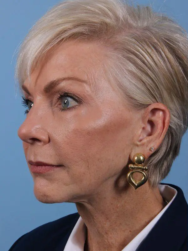 Y Lift Patient Photo - Case 16845 - before view-3