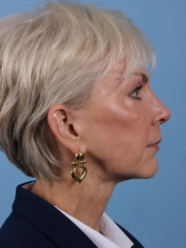 Y Lift Patient Photo - Case 16845 - before view-2