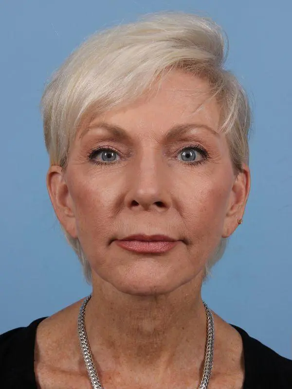 Y Lift Patient Photo - Case 16864 - before view-