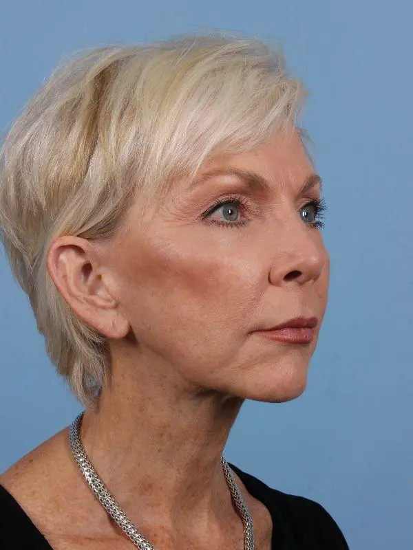 Y Lift Patient Photo - Case 16864 - before view-4