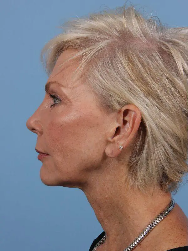 Y Lift Patient Photo - Case 16864 - before view-1