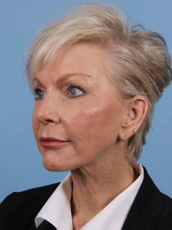 Y Lift Patient Photo - Case 16864 - after view-3