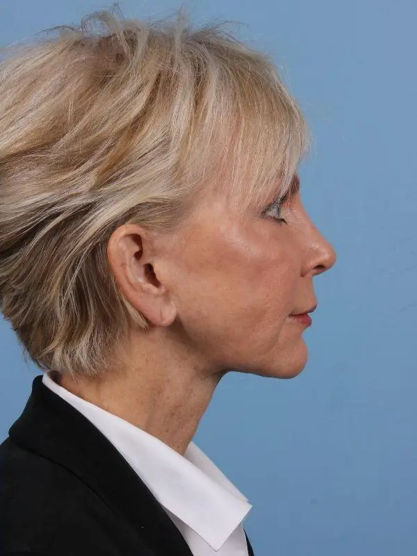 Y Lift Patient Photo - Case 16864 - after view-2