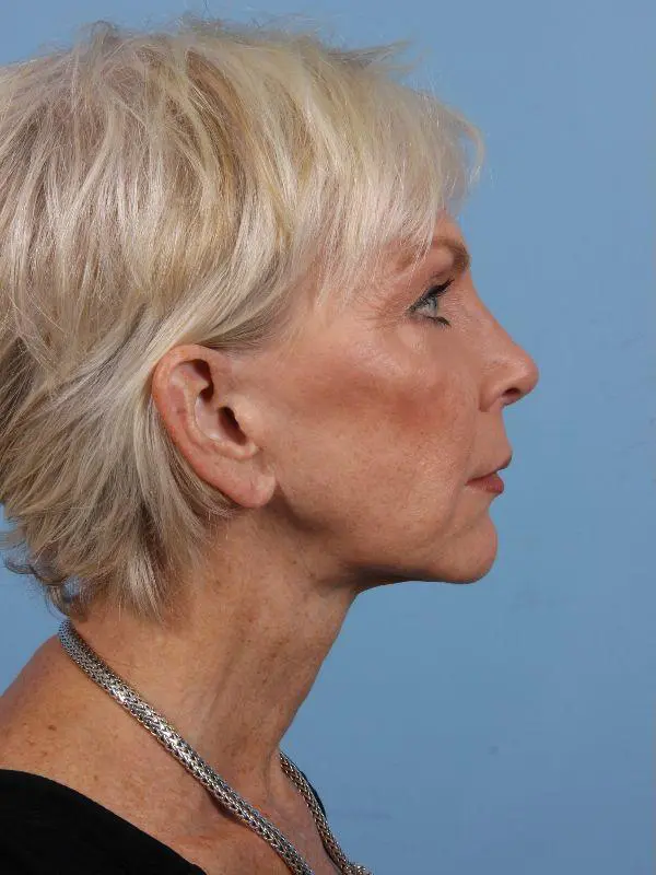 Y Lift Patient Photo - Case 16864 - before view-2