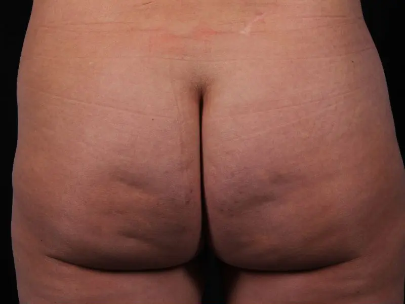 Cellulite Reduction Patient Photo - Case 16884 - before view-