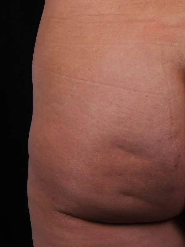 Cellulite Reduction Patient Photo - Case 16884 - before view-1