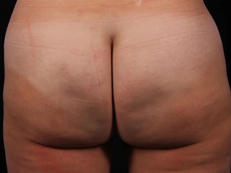 Cellulite Reduction Patient Photo - Case 16884 - after view