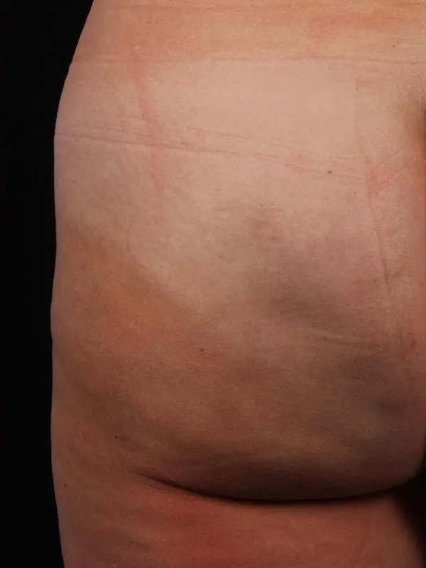 Cellulite Reduction Patient Photo - Case 16884 - after view-1