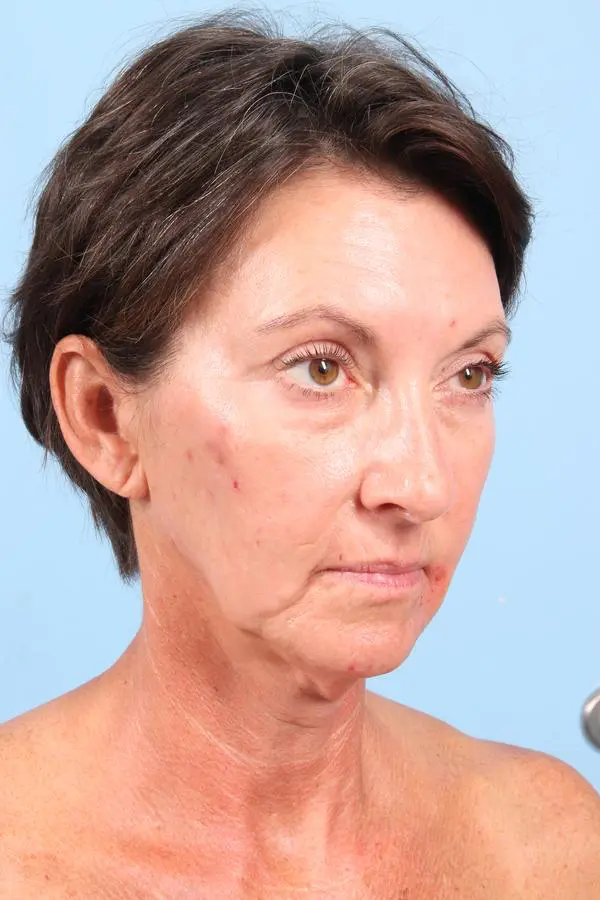 Facelift Patient Photo - Case 23042 - before view-3