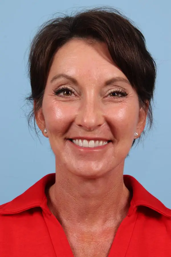 Facelift Patient Photo - Case 23042 - after view-1