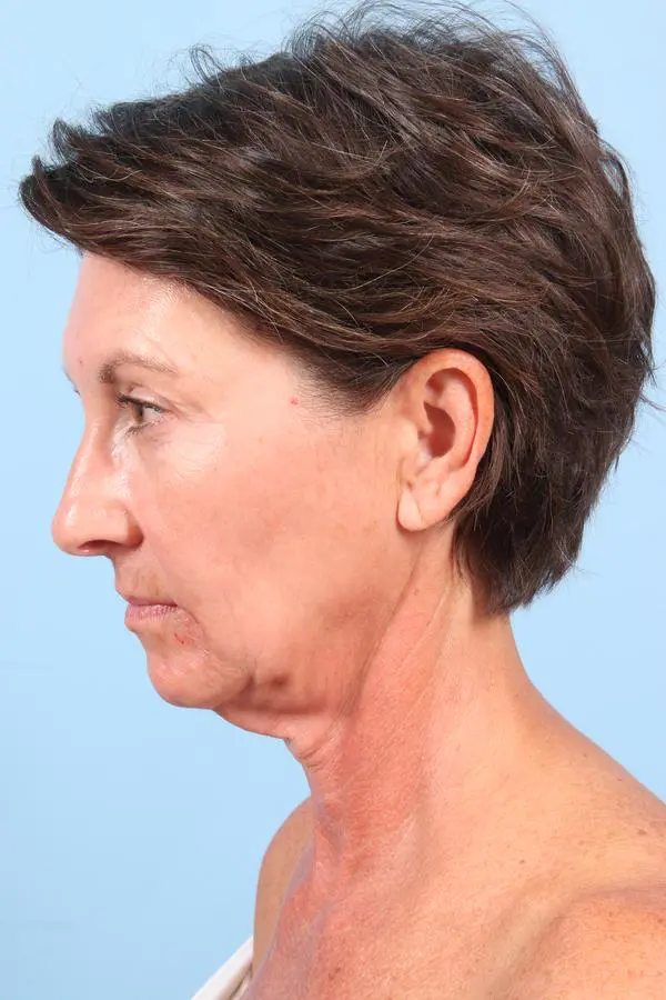 Facelift Patient Photo - Case 23042 - before view-4