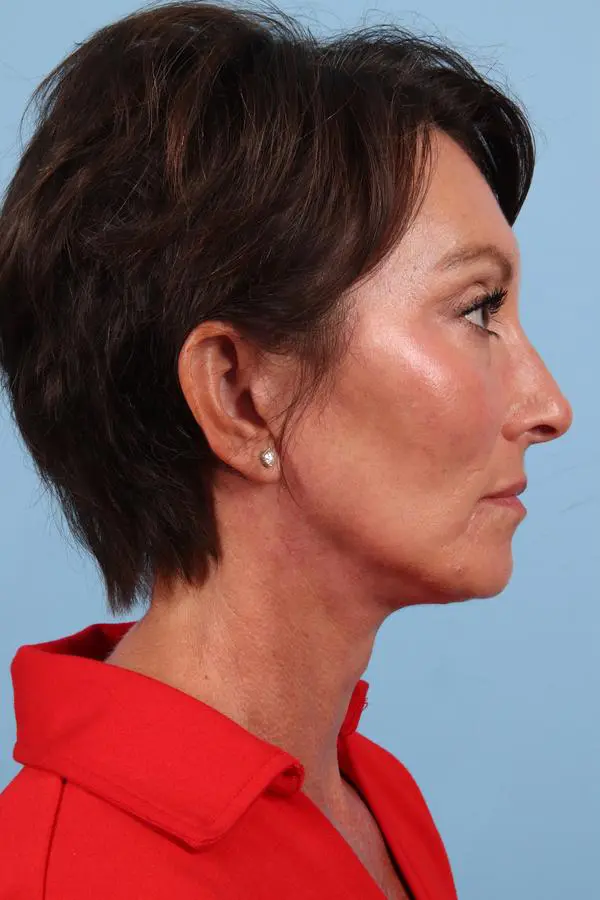 Facelift Patient Photo - Case 23042 - after view-5