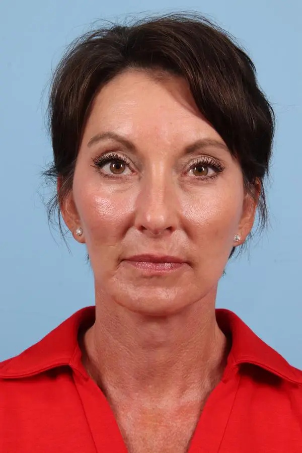 Facelift Patient Photo - Case 23042 - after view