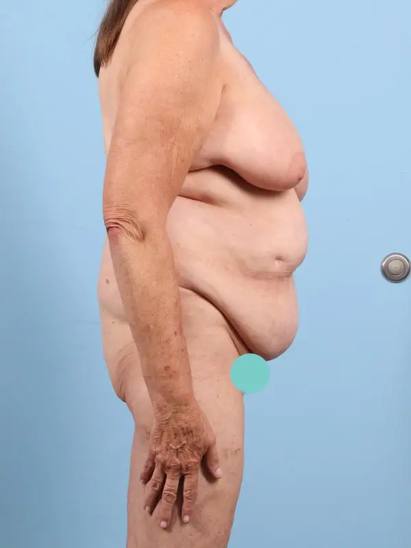 Abdominoplasty Patient Photo - Case 23174 - before view-4