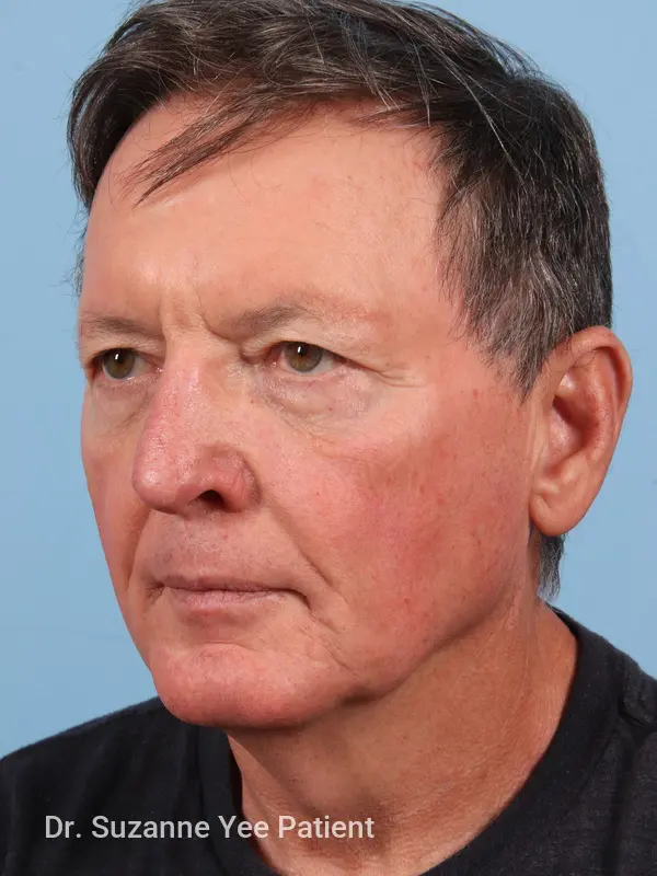 Facelift Patient Photo - Case 23503 - before view-1