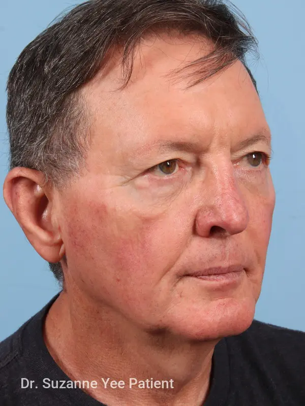 Facelift Patient Photo - Case 23503 - before view-3